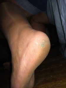 The painful step onto a plug